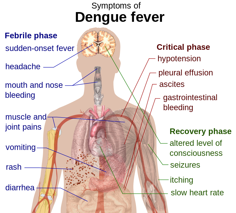 dengue signs and symptoms